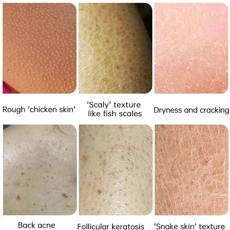 Curing Keratosis Pilaris Chicken Follicle Skin