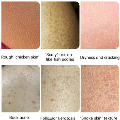 Curing Keratosis Pilaris Chicken Follicle Skin