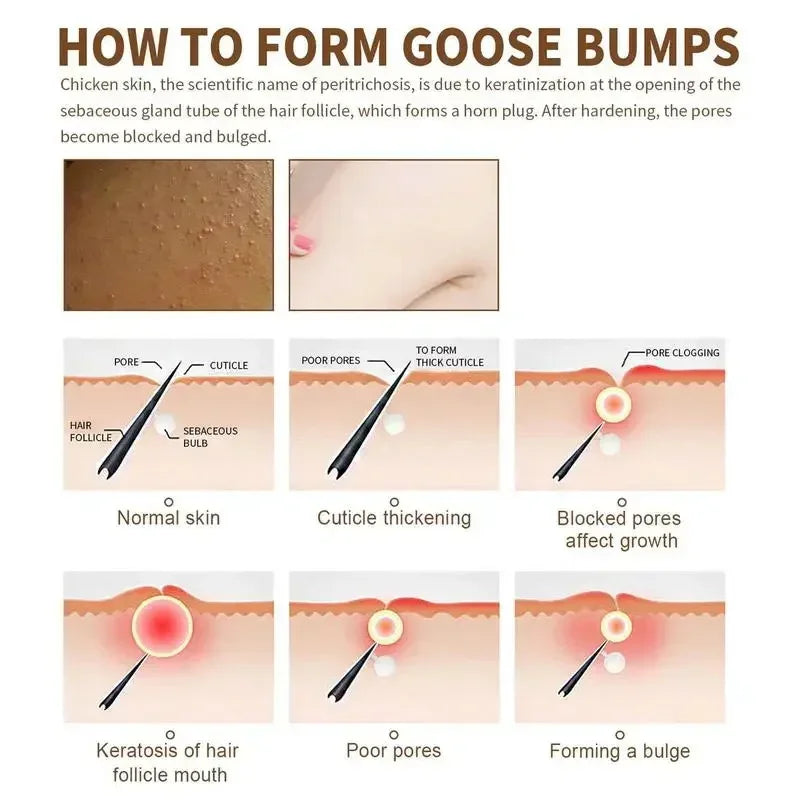 Curing Keratosis Pilaris Chicken Follicle Skin