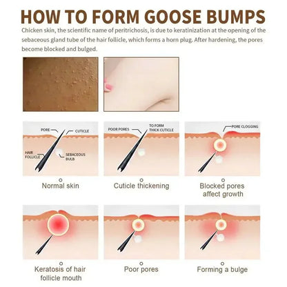 Curing Keratosis Pilaris Chicken Follicle Skin