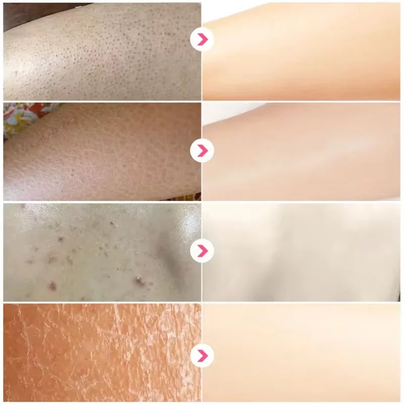 Curing Keratosis Pilaris Chicken Follicle Skin