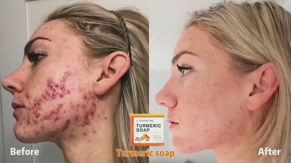 Turmeric soap before and after results
